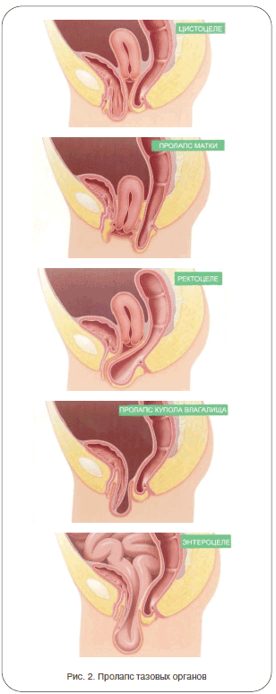 Виды тазового пролапса